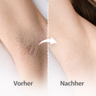 Glownetz. IPL Laser - Permanente Haarentfernung in nur 8 Wochen