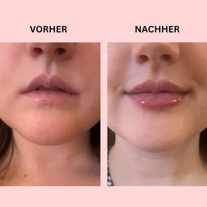 Glownetz. Liplift Roller - Mit wenigen Anwedungen zu volleren Lippen